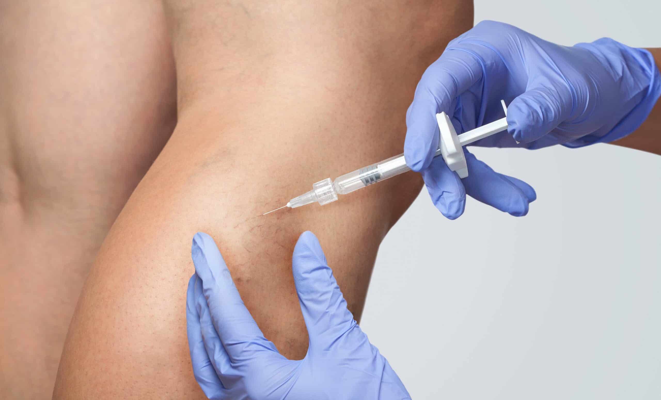 Sclerotherapy Injection | Epiphany Medspa & Wellness Fullerton, CA
