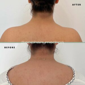 neck-before-after-Fullerton-ca