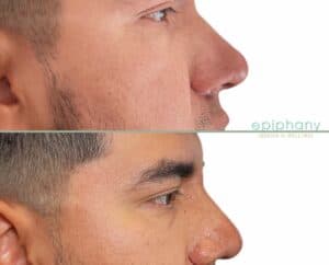 nose-before-after-Fullerton-ca