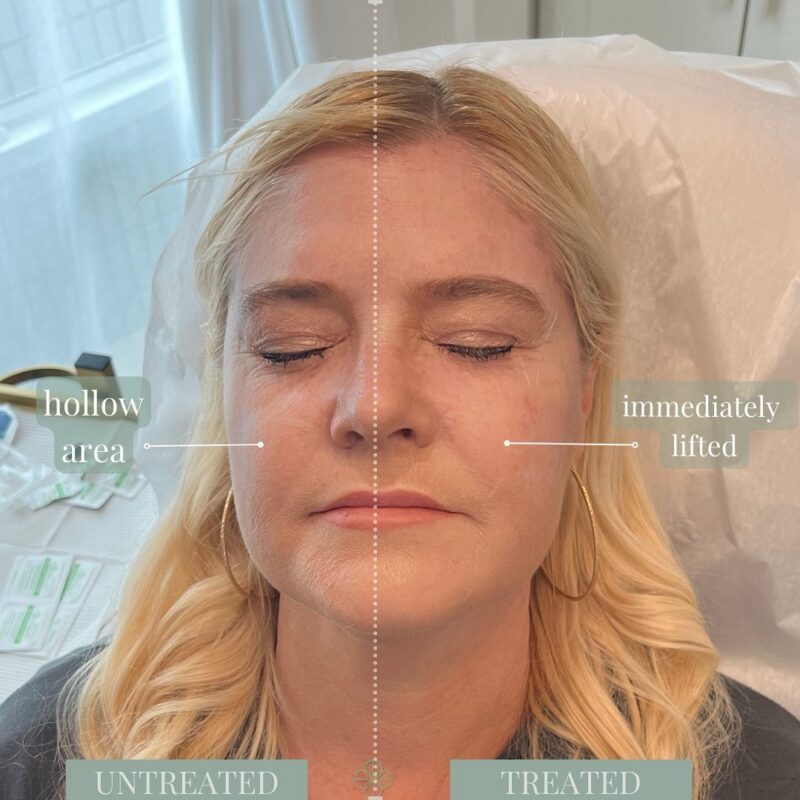 Dermal Fillers