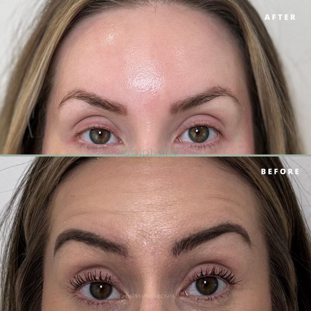 botox services