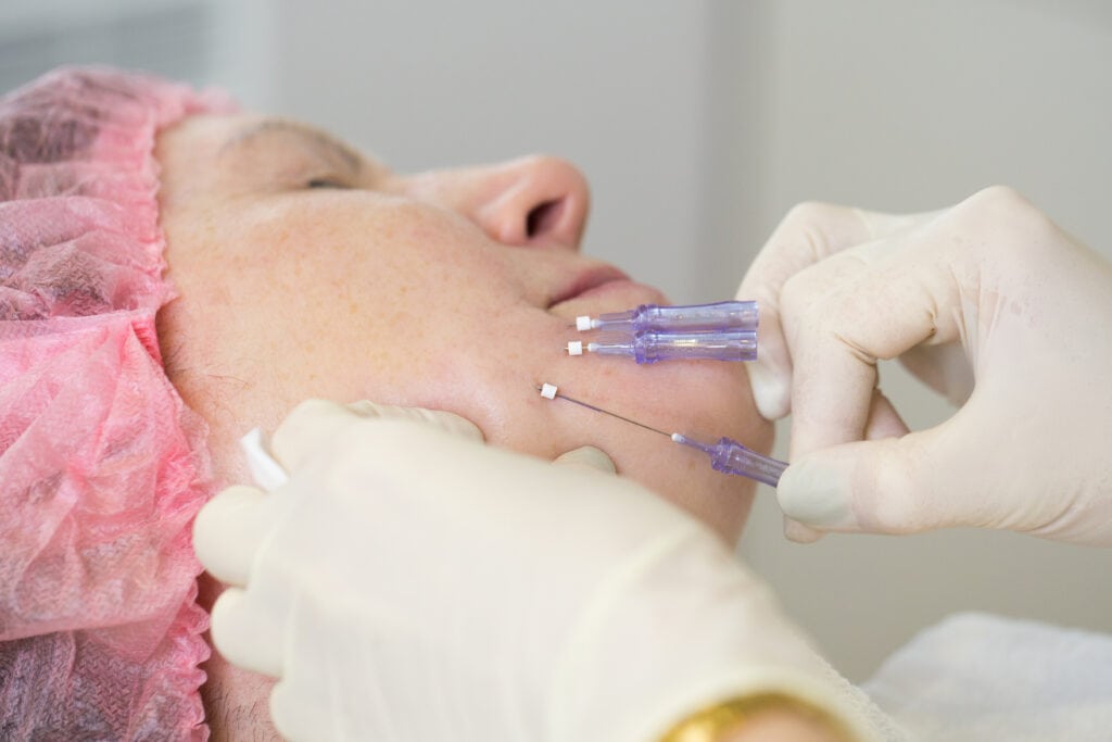 PDO Threads by DBA Epiphany Medspa in Fullerton CA