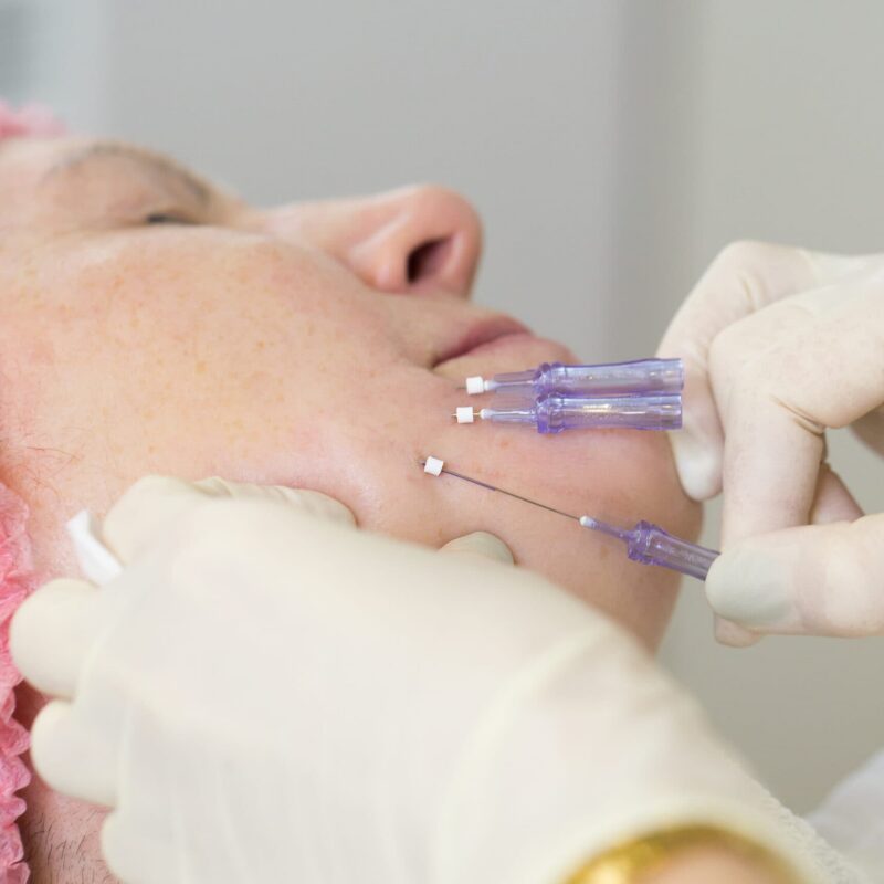 PDO Threads by DBA Epiphany Medspa in Fullerton CA