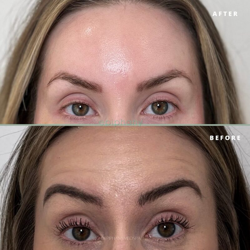 botox