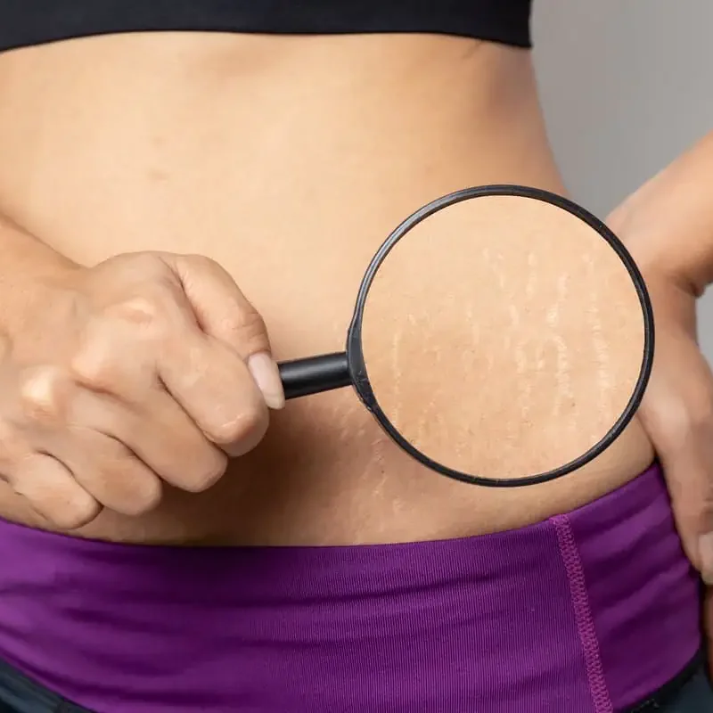 Stretch Marks-Epiphany Medspa Wellness-FULLERTON