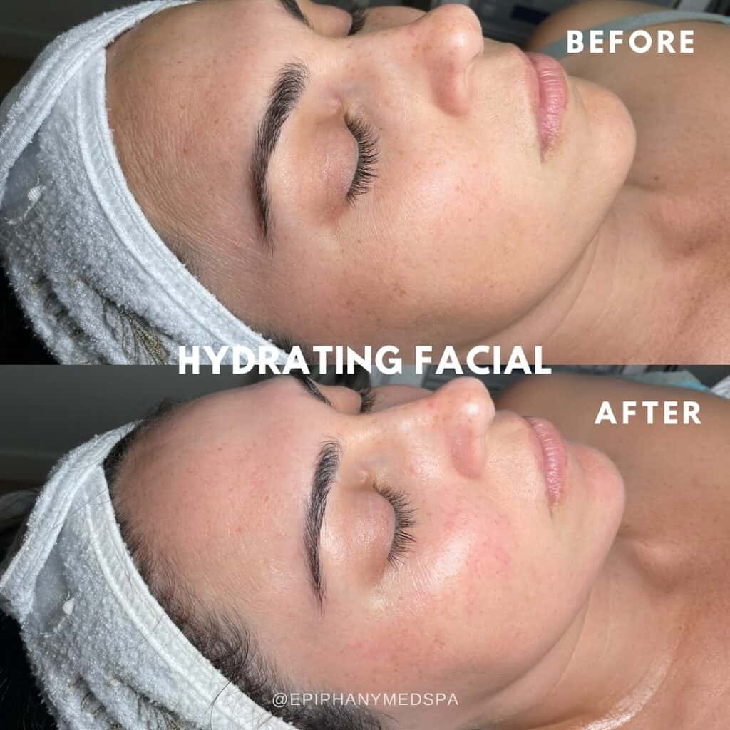Facials