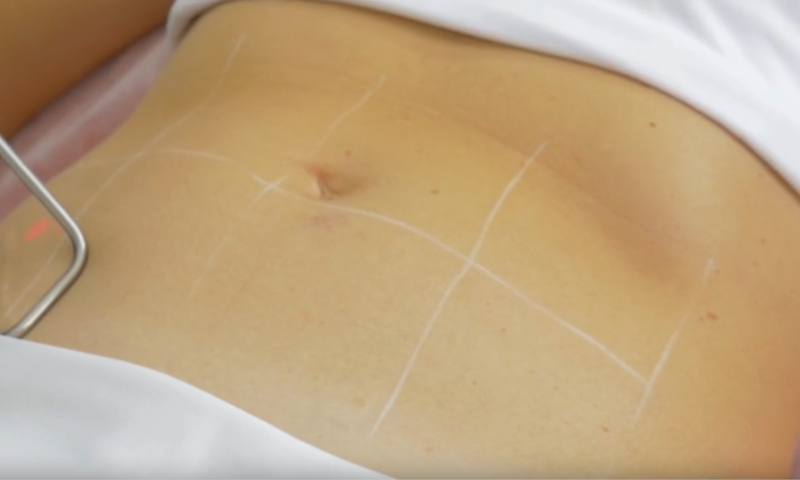 fotona body sculpt