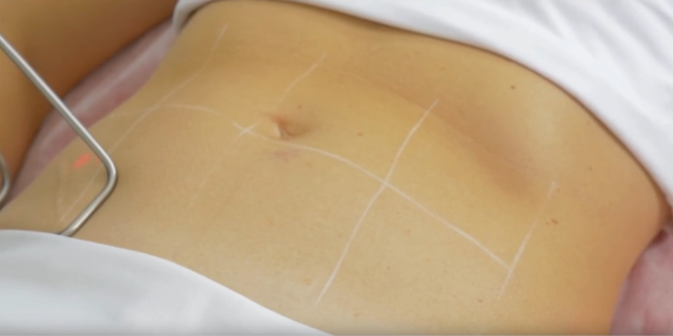 fotona body sculpt