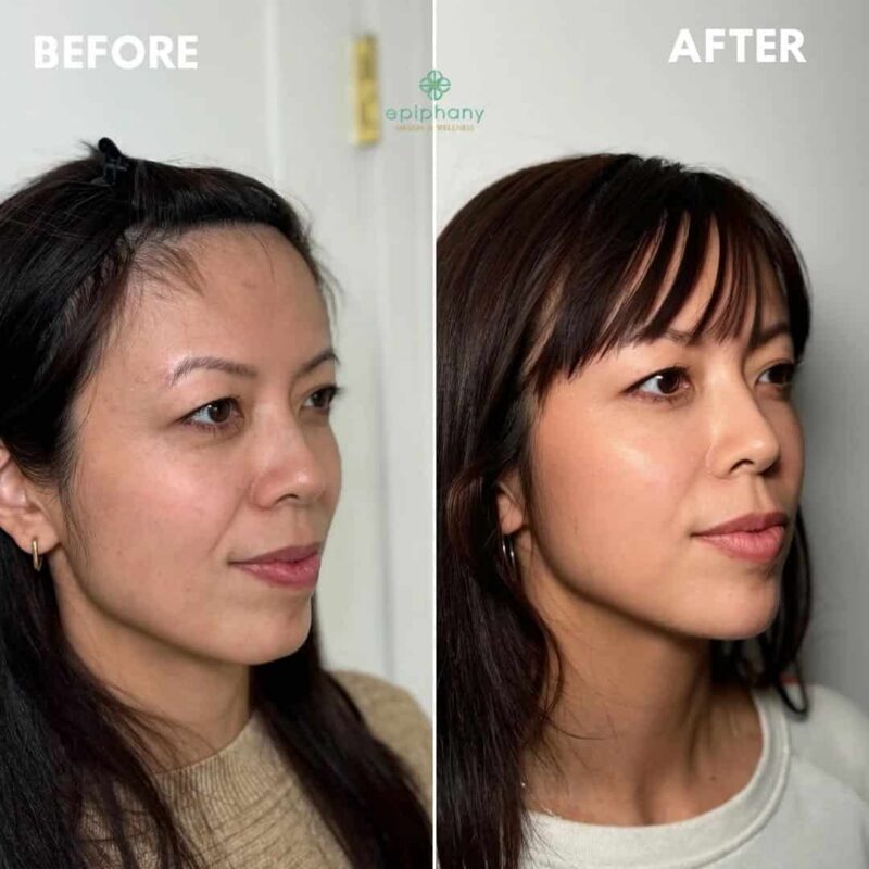 Facial Balancing with Dermal Fillers in Fullerton, CA