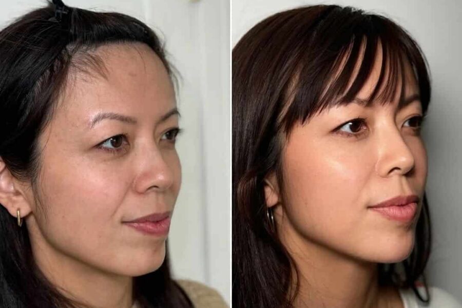 Facial Balancing with Dermal Fillers in Fullerton, CA
