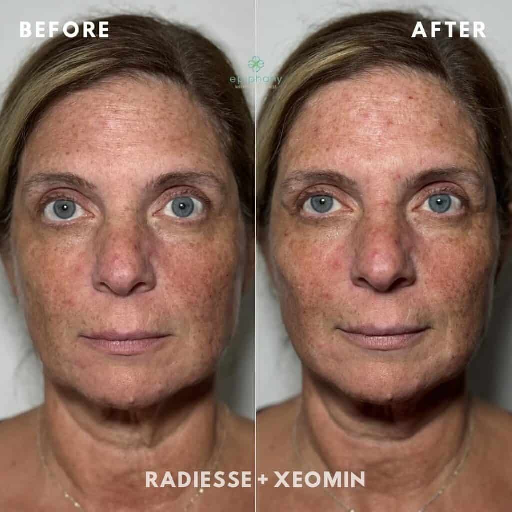 Xeomin myths debunk
